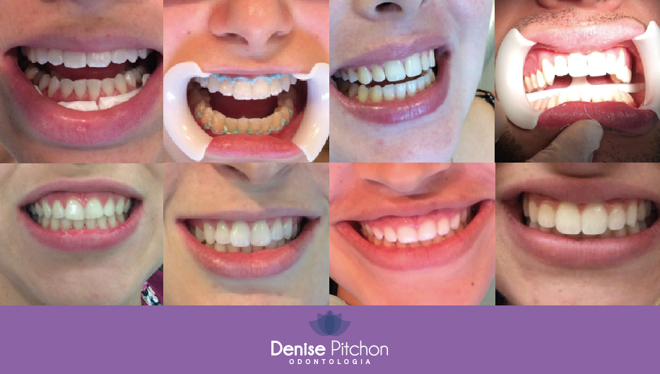 Clareamento Dental